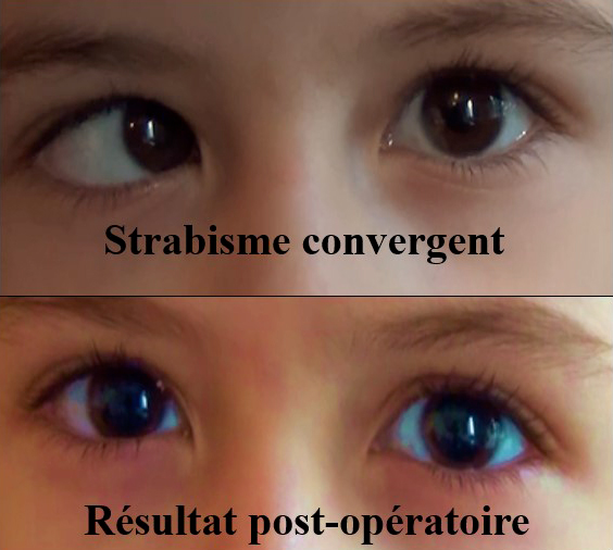 opération d'un strabisme convergent