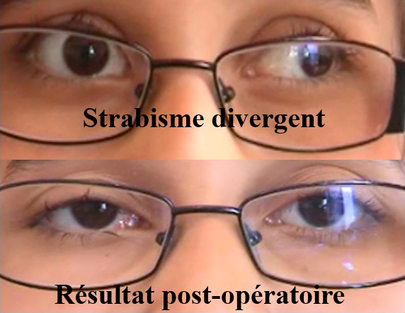 opération d'un strabisme divergent