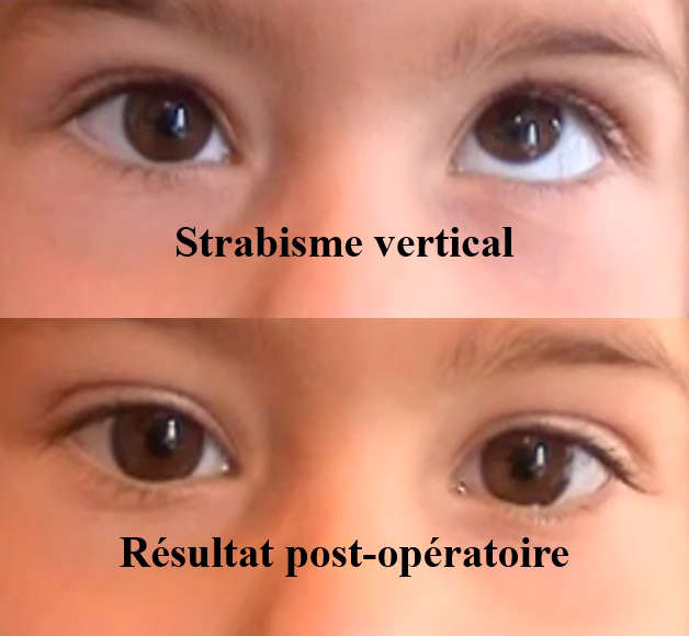 opération d'un strabisme vertical