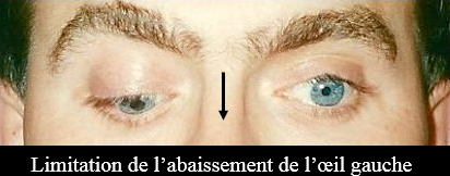 limitation de l'abaissement de l'oeil gauche