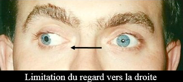 limitation du regard vers la droite