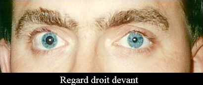 paralysie oculomotrice regard droit devant