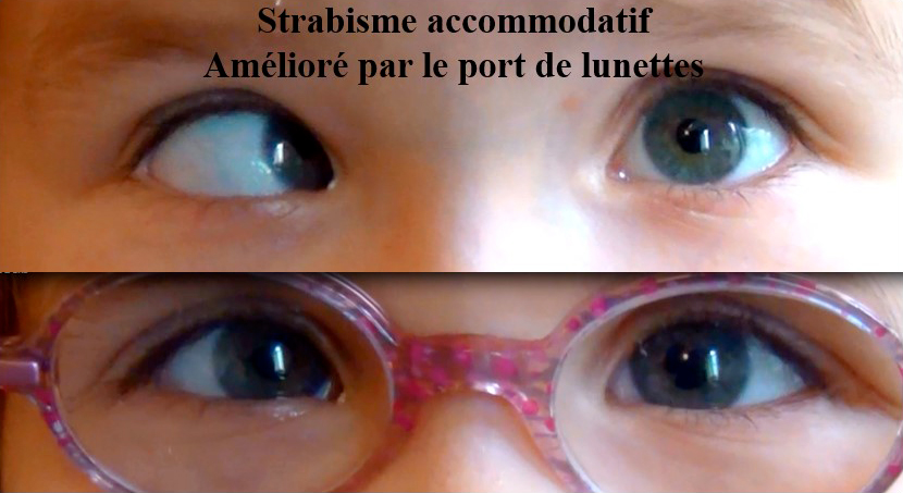 strabisme accommodatif