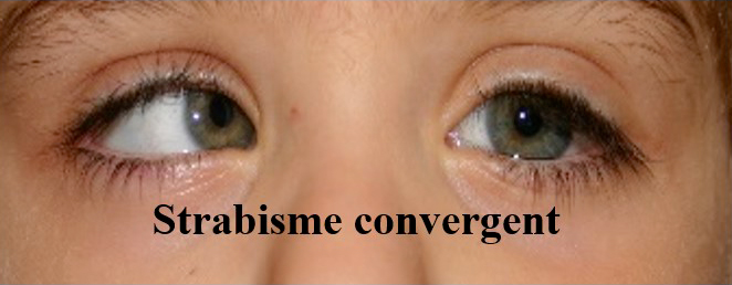 strabisme convergent