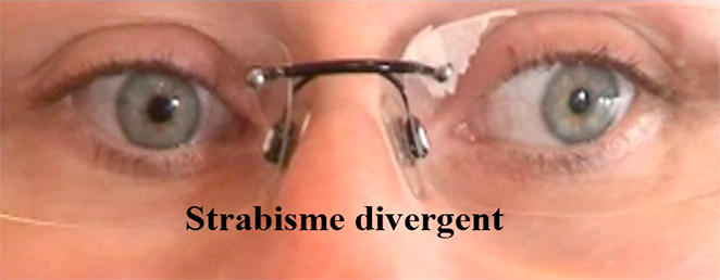 strabisme divergent