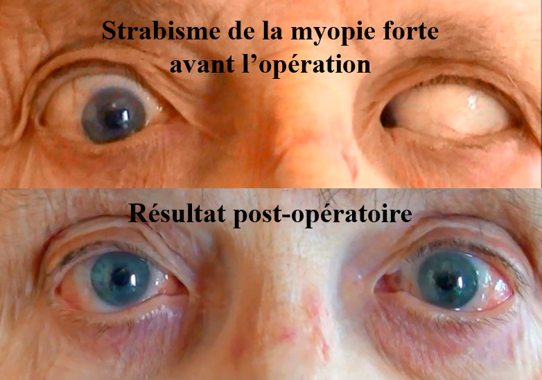 strabisme de la myopie forte