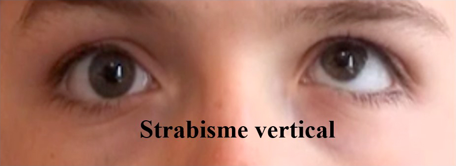 strabisme vertical