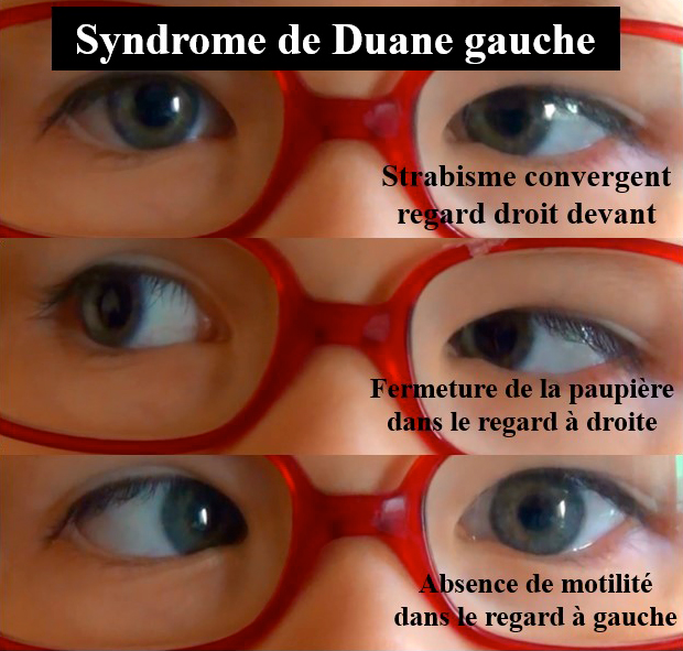 syndrome de duane