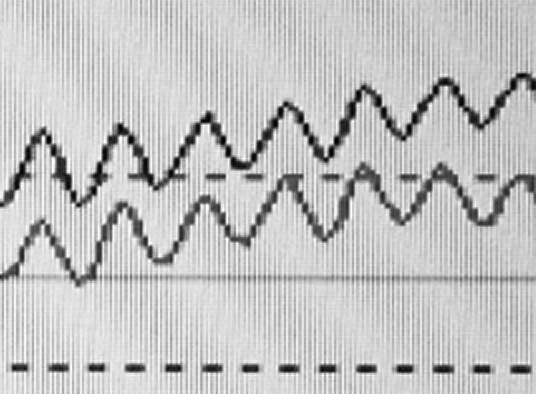 nystagmus