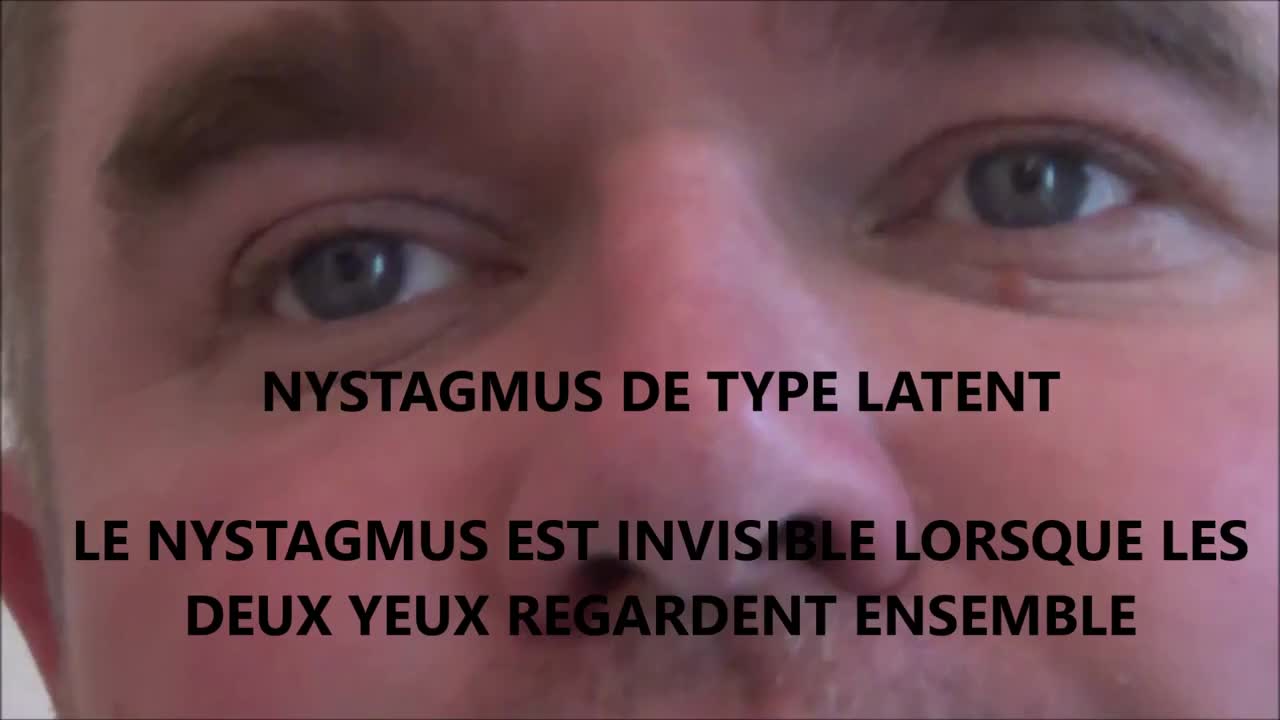 Nystagmus congénital ou acquis : causes et traitement | Strabismes.fr